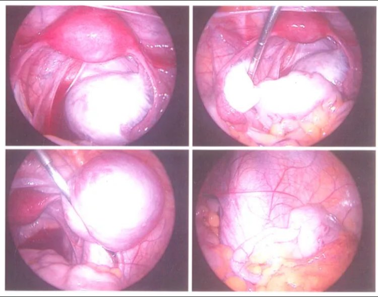 Options for Medical and Natural Treatment of Endometriosis